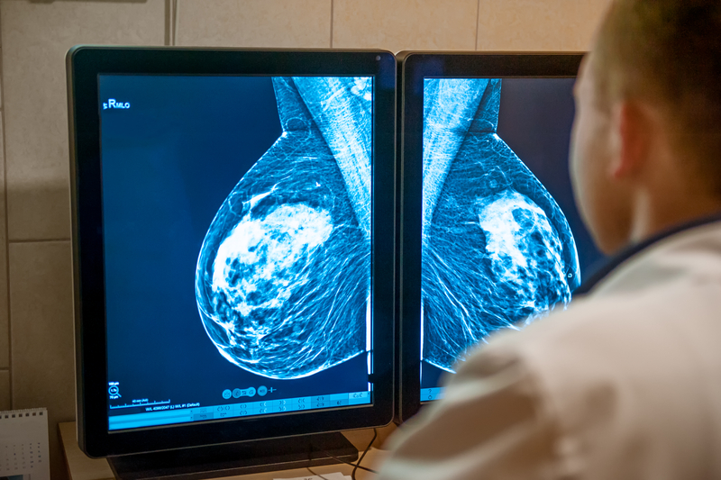Un test genetic inovator poate oferi milioanelor de paciente cu cancer de sân oportunitatea de a evita chimioterapia.